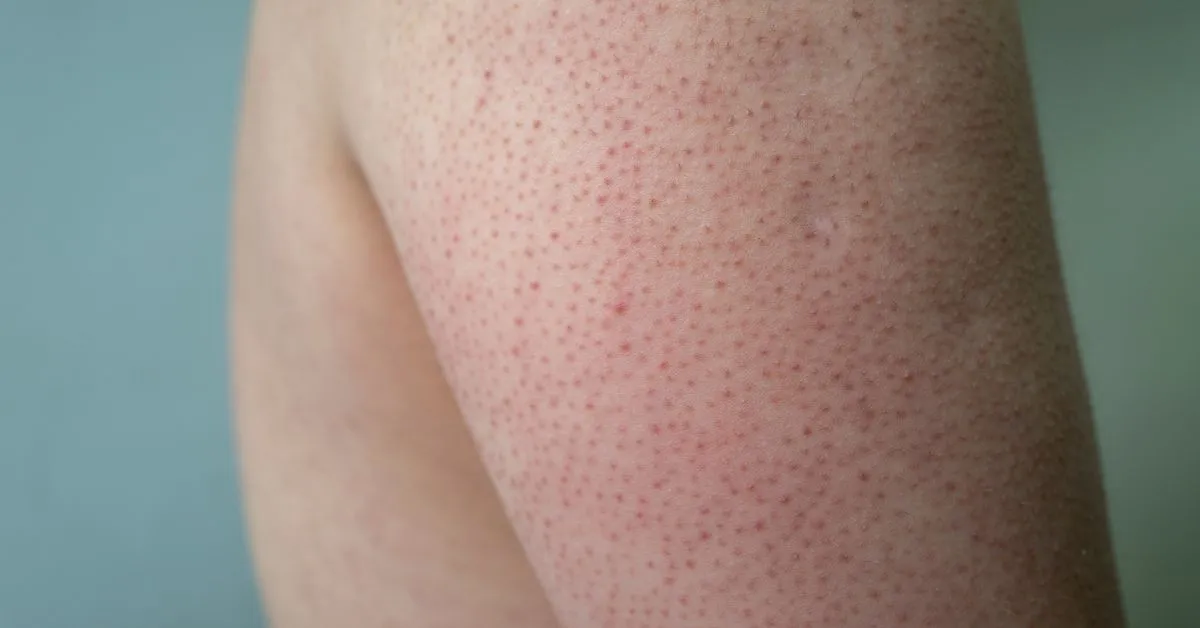Treatment For Keratosis Pilaris