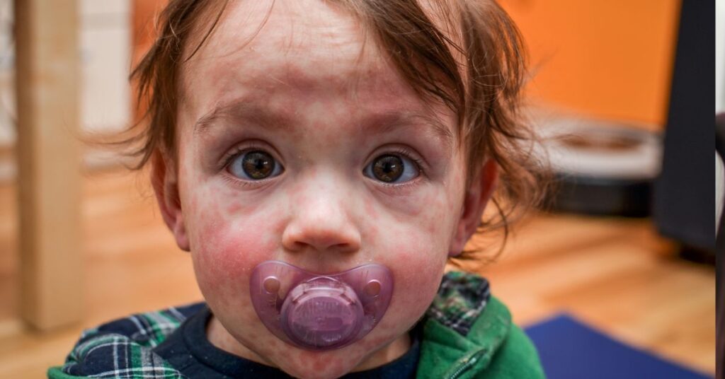 A baby has a measles rash on his face.
