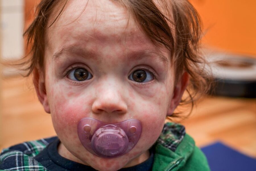 A baby has a measles rash on his face.