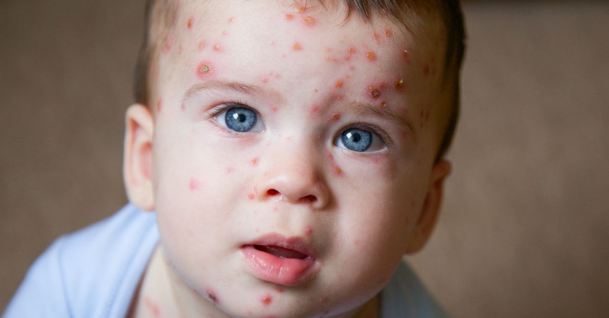 Varicella (Chickenpox)