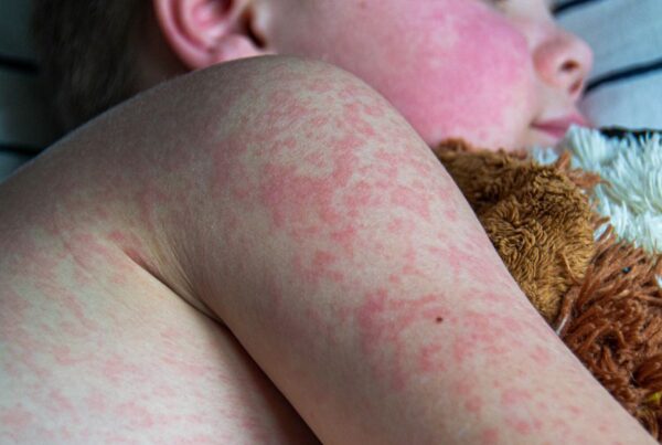 A child has a measles rash.