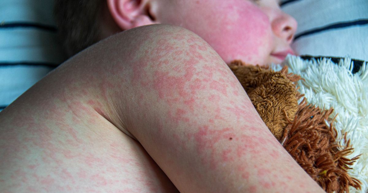Measles Symptoms, Complications, and Effective Home Care Tips