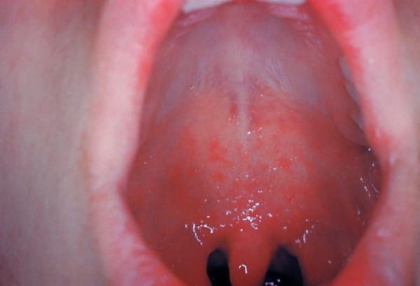 Koplik spots in the back of the throat.
