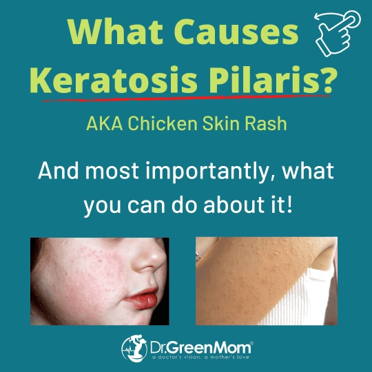 A graphic with images of the skin condition Keratosis Pilaris (aka Chicken Skin Rash).