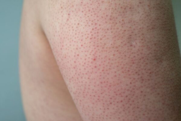 Keratosis Pilaris (chicken rash) on the back of a teen's arm.