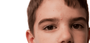 Molluscum Contagiosum bumps on the face of a young boy. (Raised flesh-colored bumps.)