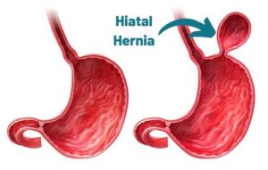 A healthy stomach without a hernia and a stomach with a hiatal hernia where a part of the stomach bulges up above the diaphragm.