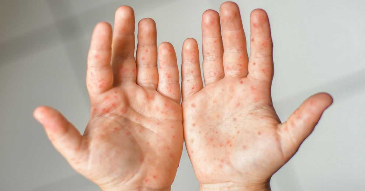 Two hands covered in the red spots of the hand-foot-and-mouth disease rash.