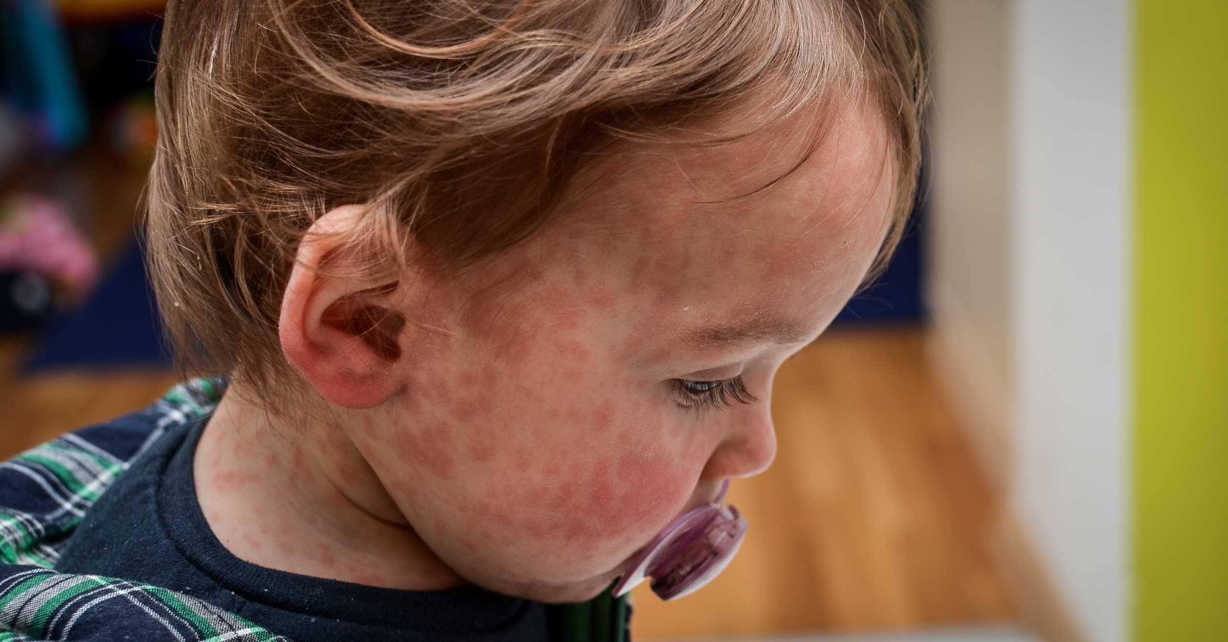 A baby has the measles rash on his face.
