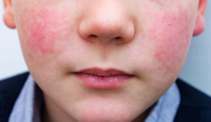 A boy has red cheeks from a viral rash.