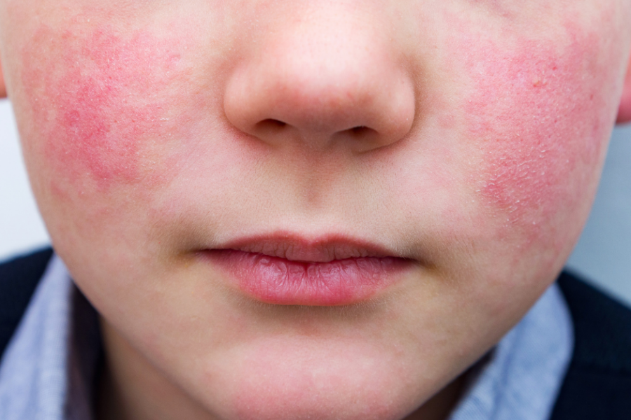 A boy has red cheeks from a viral rash.