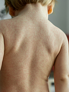A boy with a viral rash on his back. 