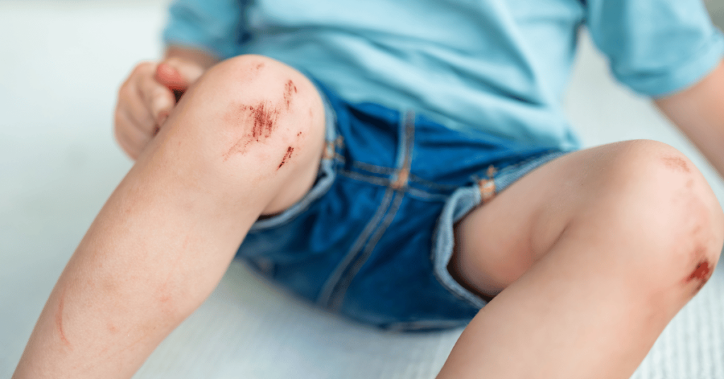 A boy's knees are covered in scrapes.