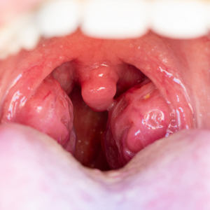 Enlarged tonsils in an open mouth.