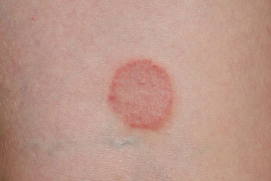 A ringworm rash on the skin.