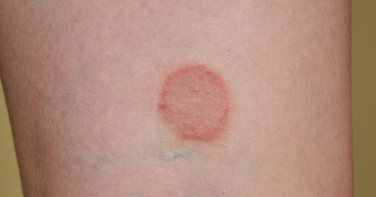 All About Ringworm: Causes, Remedies, & When to See a Doctor