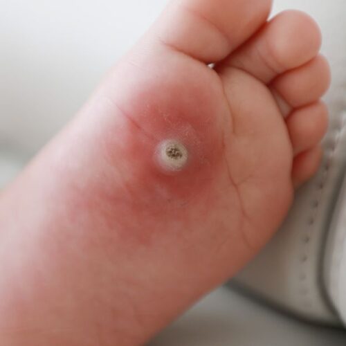 A plantar wart on the foot of a child.