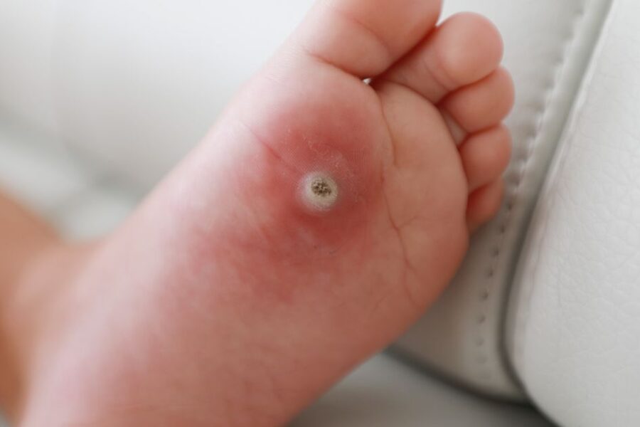 A plantar wart on the foot of a child.
