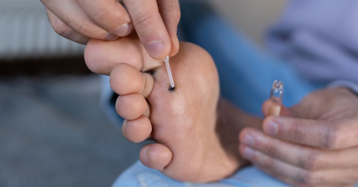 What Parents Need to Know About Plantar Warts - Dr. Green Mom