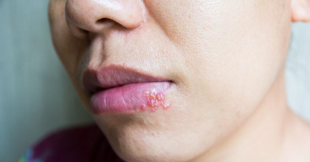 A woman has a cold sore on her mouth.