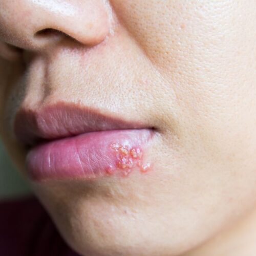 A woman has a cold sore on her mouth.
