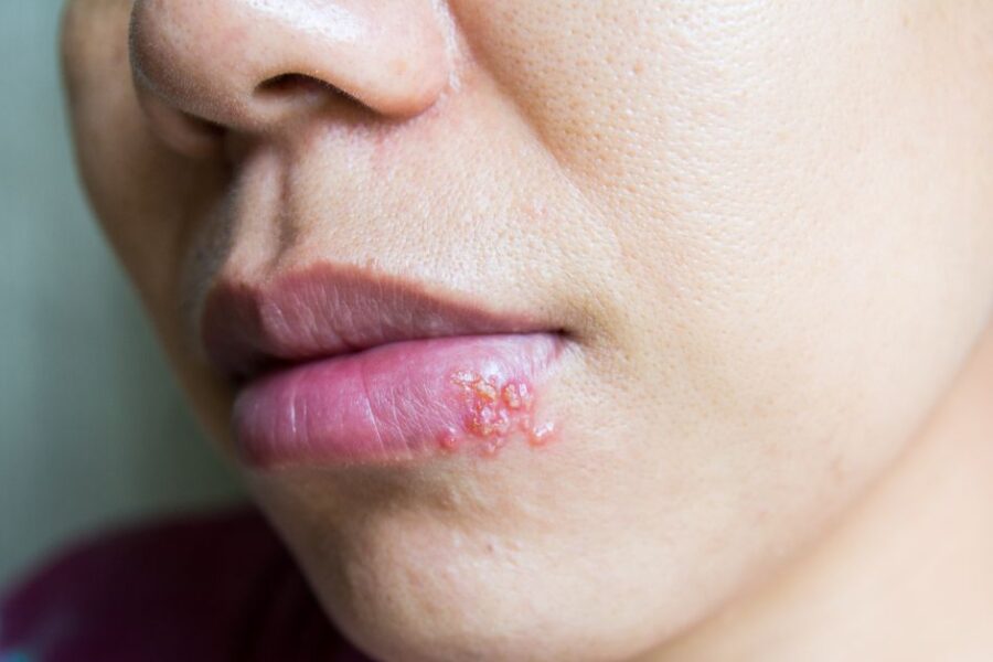 A woman has a cold sore on her mouth.