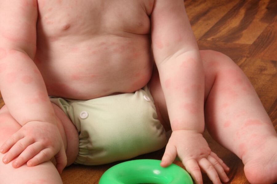 A baby covered in hives sits on a wooden floor playing with a green toy.