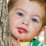 A young child with impetigo on his chin.