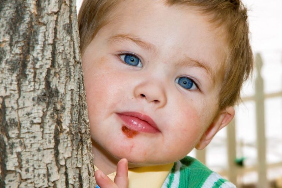 A young child with impetigo on his chin.