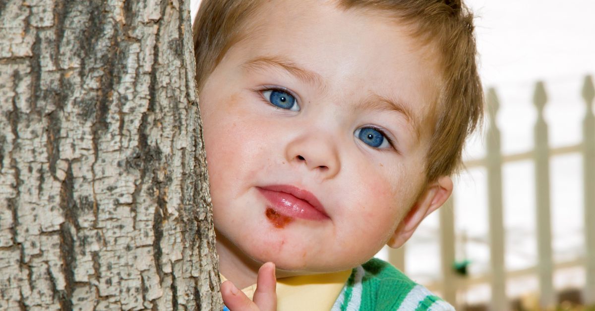 A young child with impetigo on his chin.