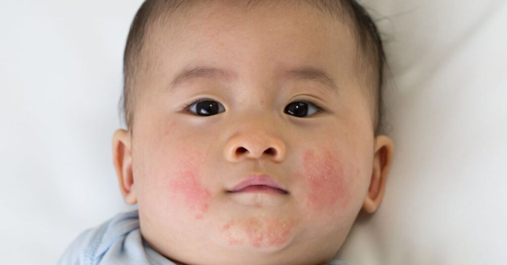 Drool Rash in Babies and Toddlers: A Guide for Parents - Dr. Green Mom