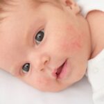 A baby with a rash on her cheeks.