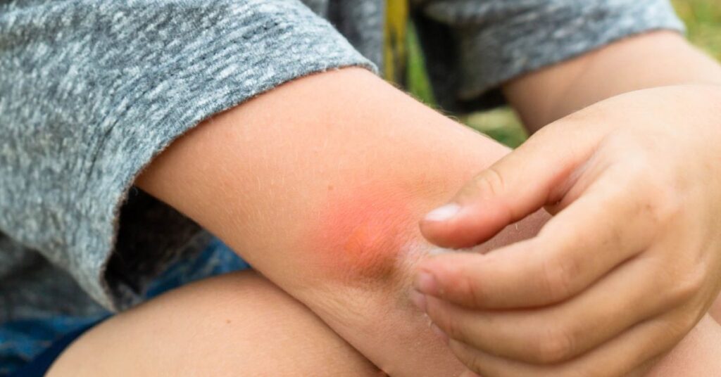 A boy itches a mosquito bite on his elbow.