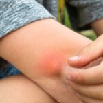 A boy itches a mosquito bite on his elbow.
