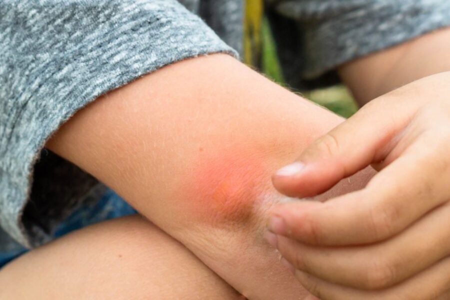 A boy itches a mosquito bite on his elbow.
