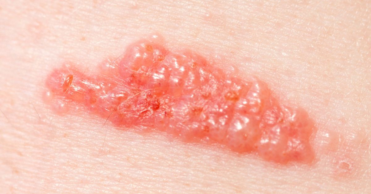 Poison Ivy, Poison Oak & Poison Sumac - Dr. Green Mom