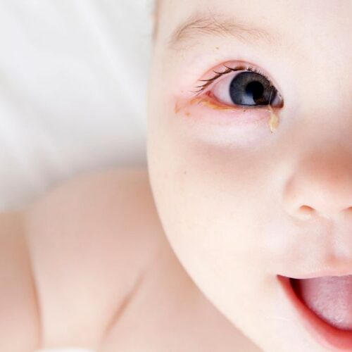 A baby with pink eye lays on a white blanket.