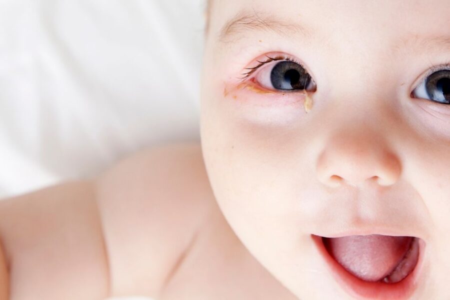 A baby with pink eye lays on a white blanket.