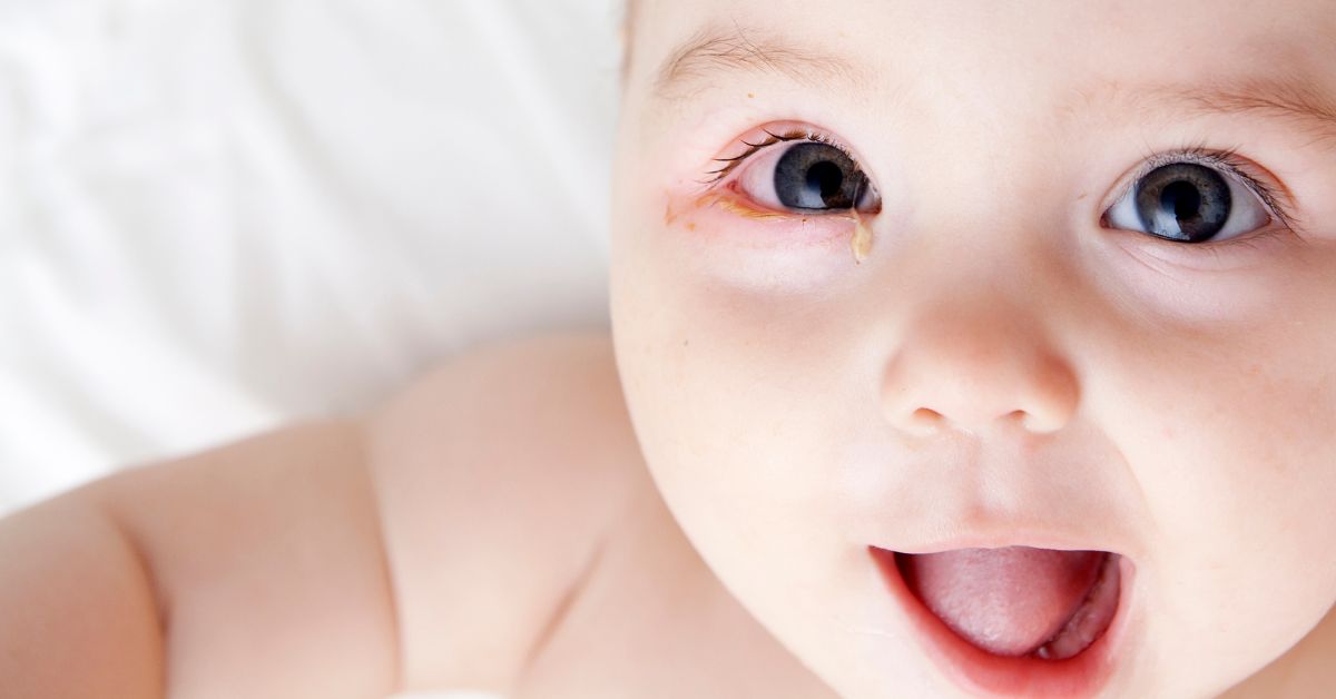 A baby with pink eye lays on a white blanket.